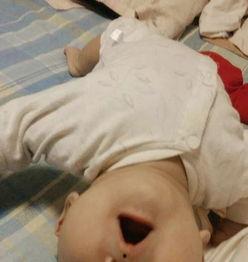 婴儿脑瘫照片,揭示早期症状与关爱之道